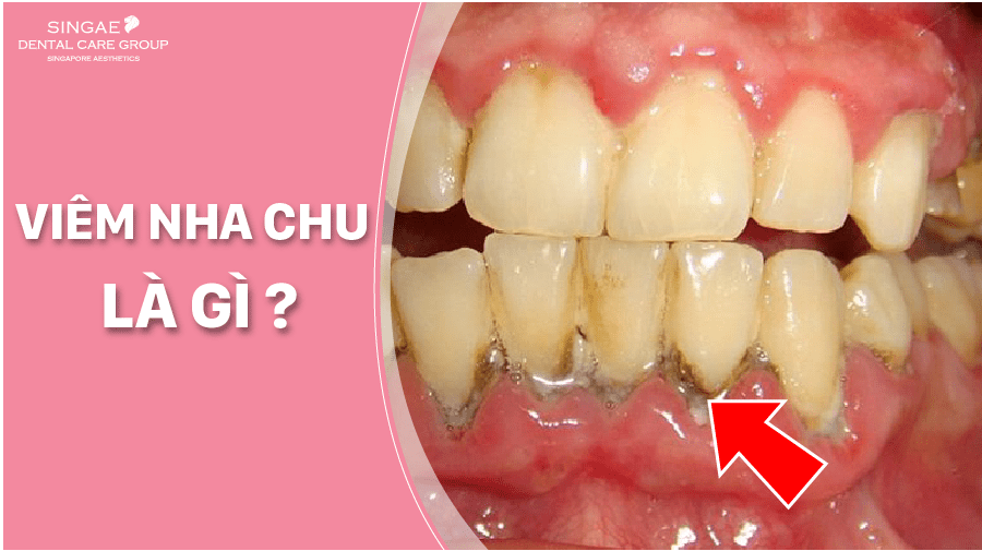 Bệnh viêm lợi, viêm nha chu