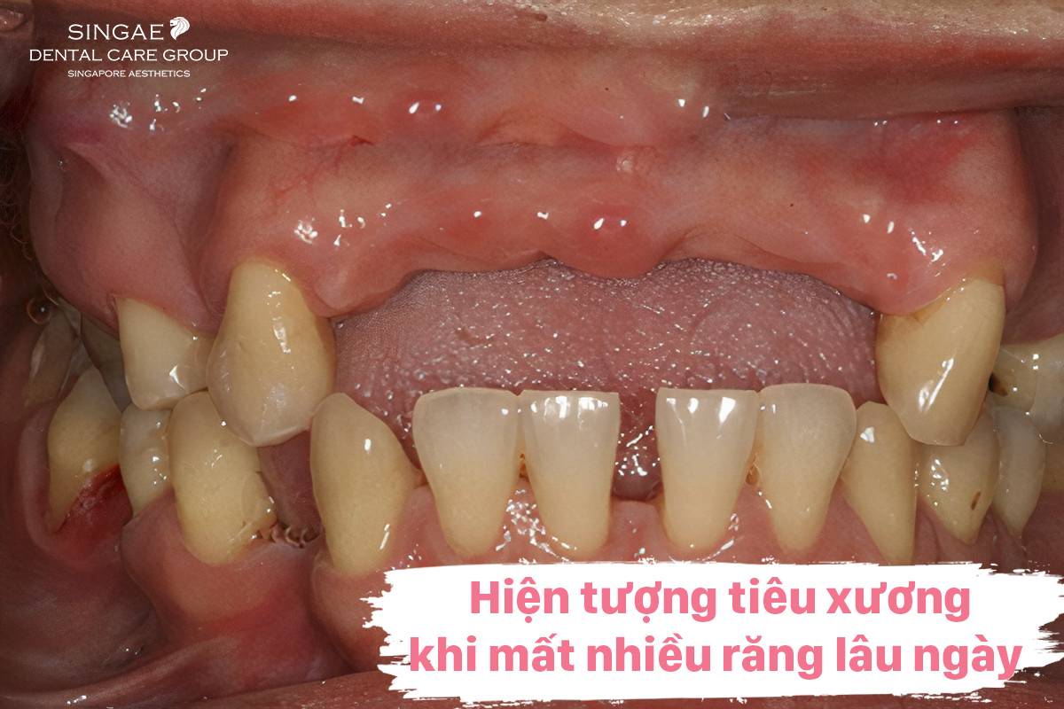 Nguyên nhân tiêu xương 