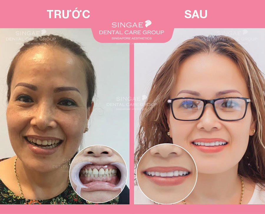 Nha khoa Singae ở đâu? Dịch vụ có tốt không? Bảng giá thế nào? 12 Chị Thanh Bình