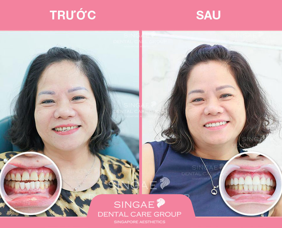 Nha khoa Singae ở đâu? Dịch vụ có tốt không? Bảng giá thế nào? 10 Chị Ngọc Diệp