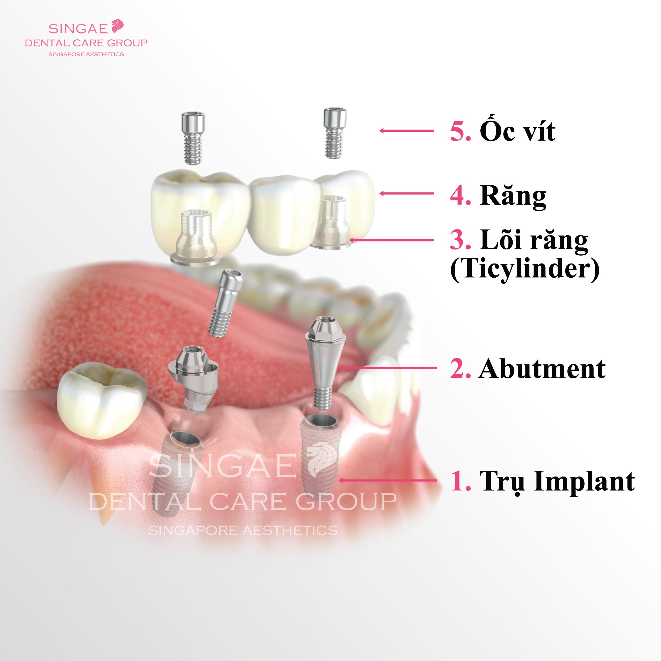 Cấu tạo trụ Implant