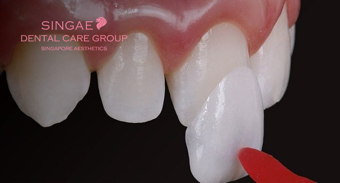 Nha khoa Singae ở đâu? Dịch vụ có tốt không? Bảng giá thế nào? 11 Dán sứ Veneer