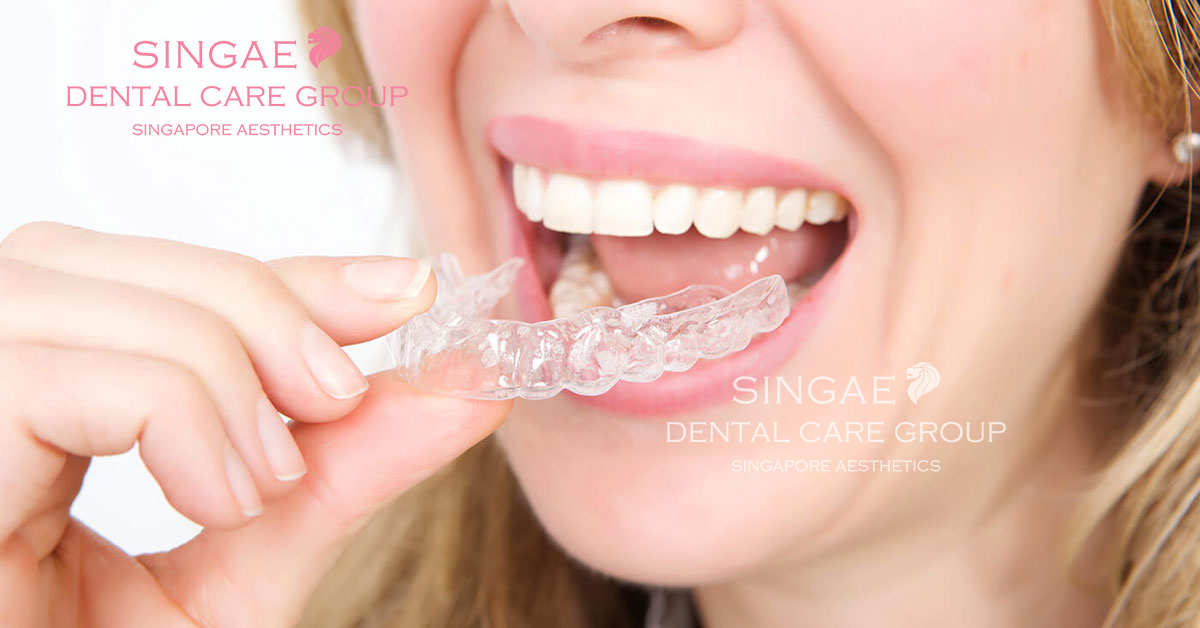Nha khoa Singae ở đâu? Dịch vụ có tốt không? Bảng giá thế nào? 13 niềng răng