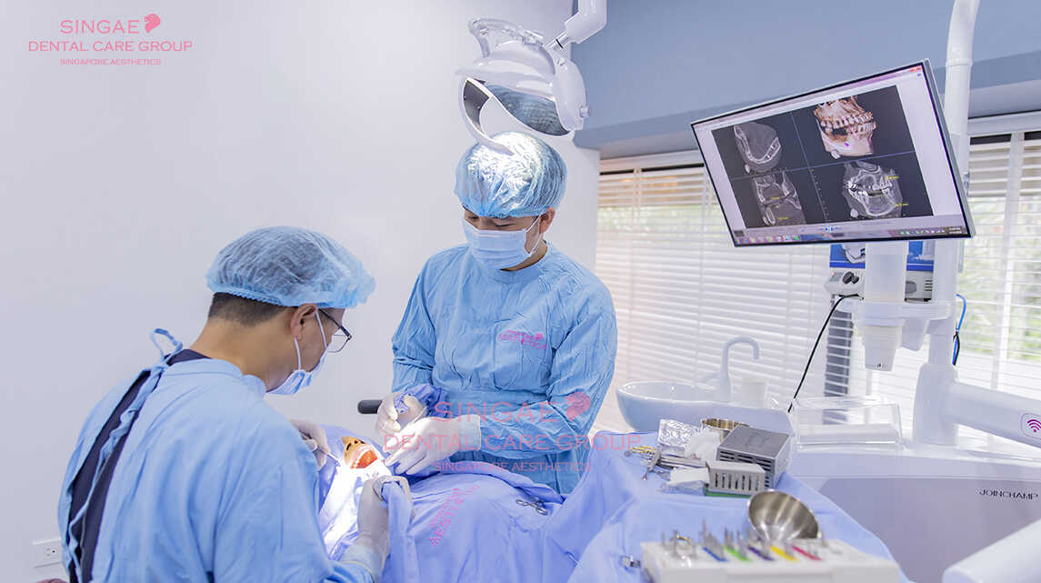 Giải đáp : Toàn bộ quy trình trồng răng implant mất bao lâu ?