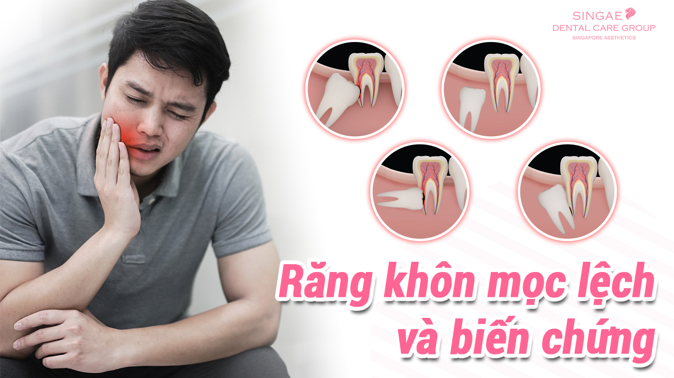 Răng khôn mọc lệch là gì? Răng khôn mọc lệch có nên nhổ không?