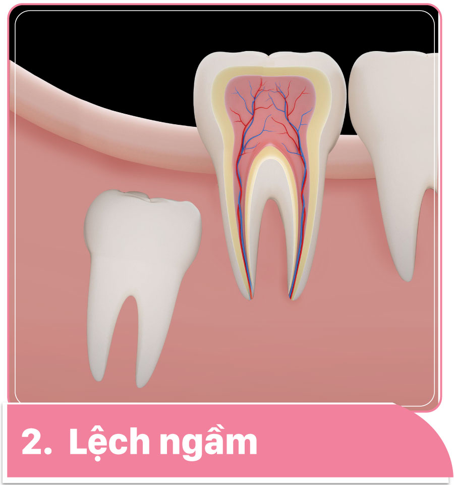Phân loại các trường hợp răng khôn mọc ngầm 18 Răng khôn mọc ngầm