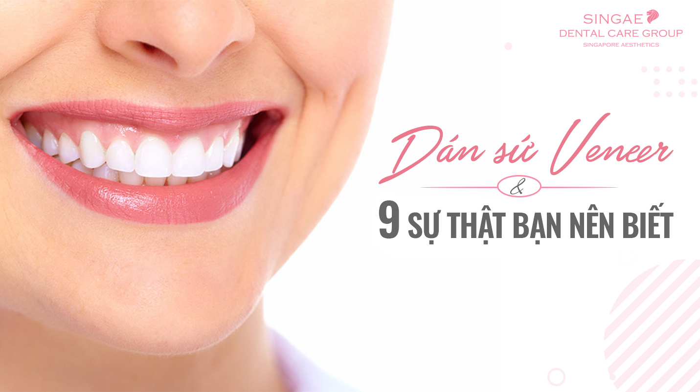 [ Tổng hợp ] 9+ sự thật về dán răng sứ Veneer bạn cần biết?
