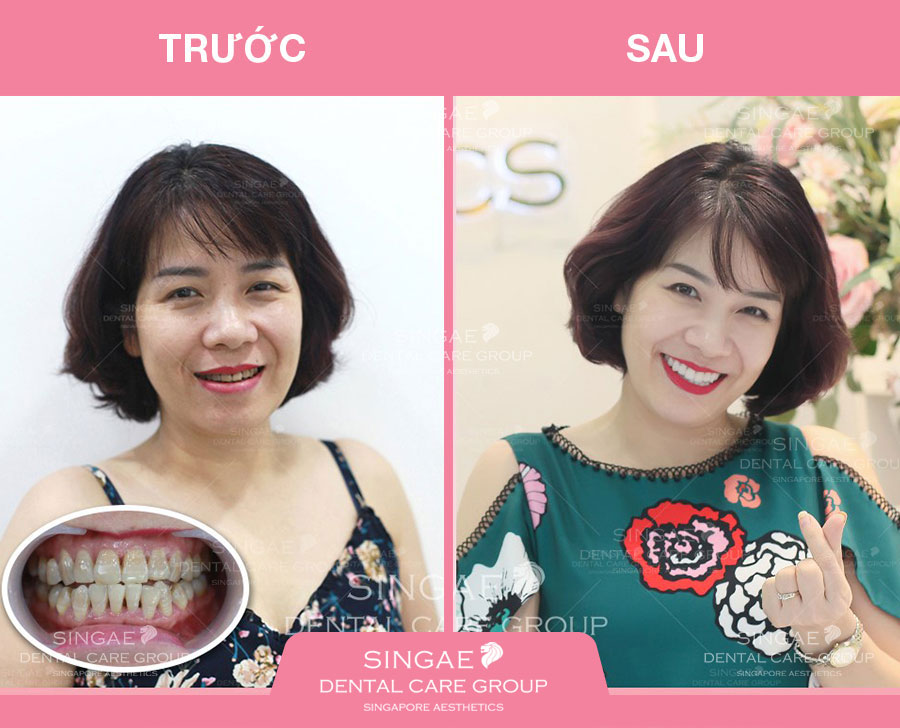 Răng sứ cao cấp 