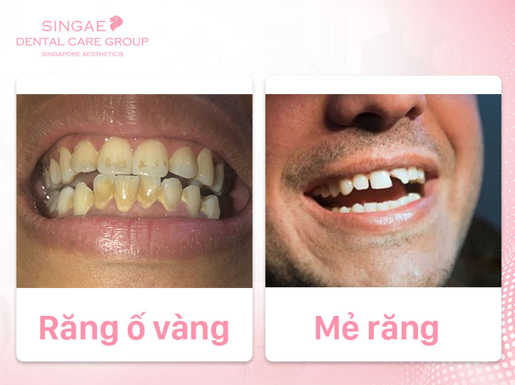 răng mẻ, ố vàng