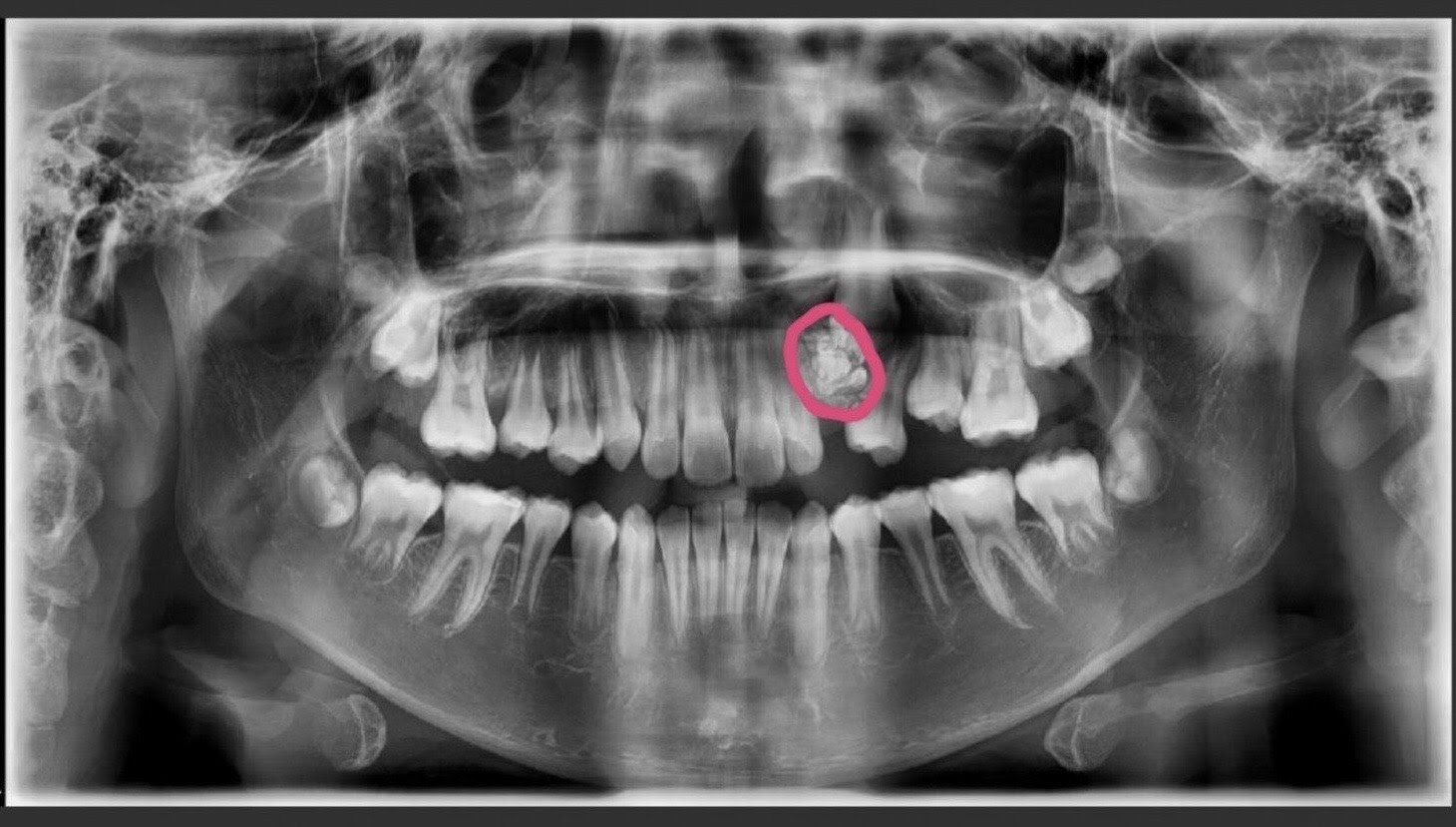 Phát hiện u nang xương từ chụp phim CT 