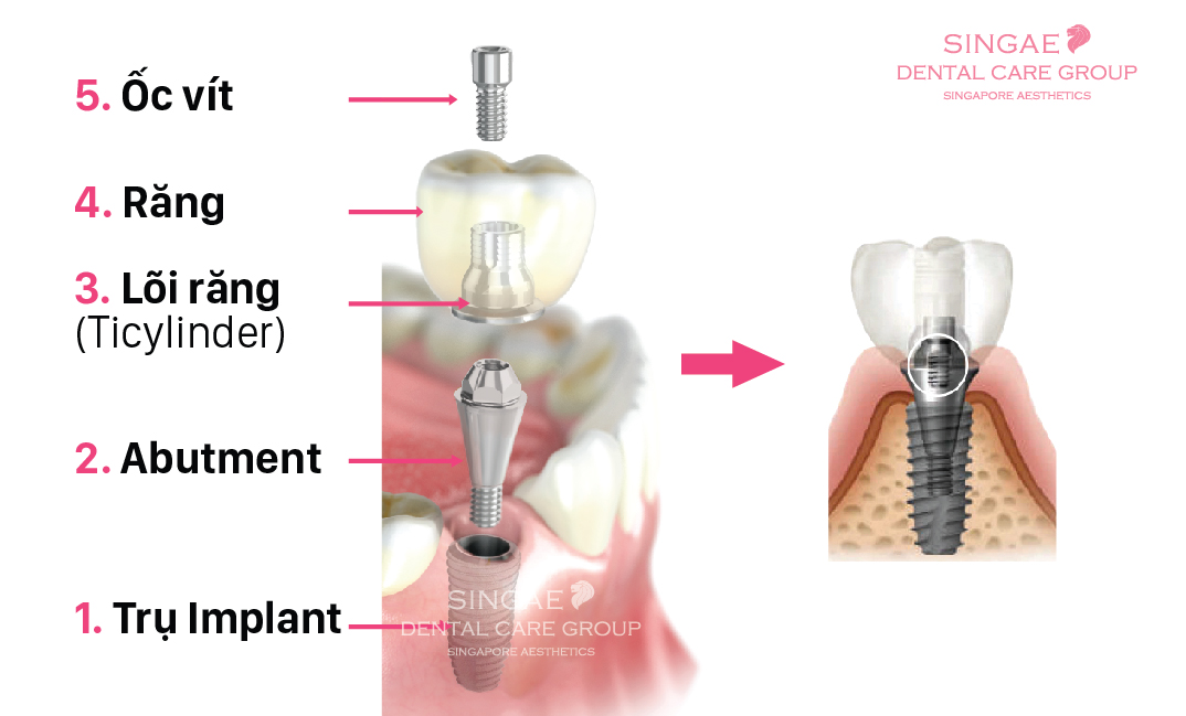 Cấu trúc của một chiếc răng Implant