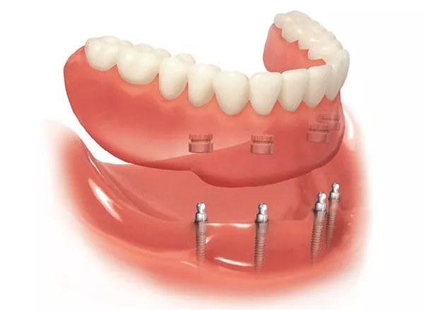 Kết nối bằng ốc vít nên Mini Implant dễ dàng tháo lắp để vệ sinh khi cần thiết