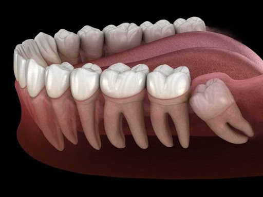 Hình ảnh răng khôn mọc ngầm 45 độ