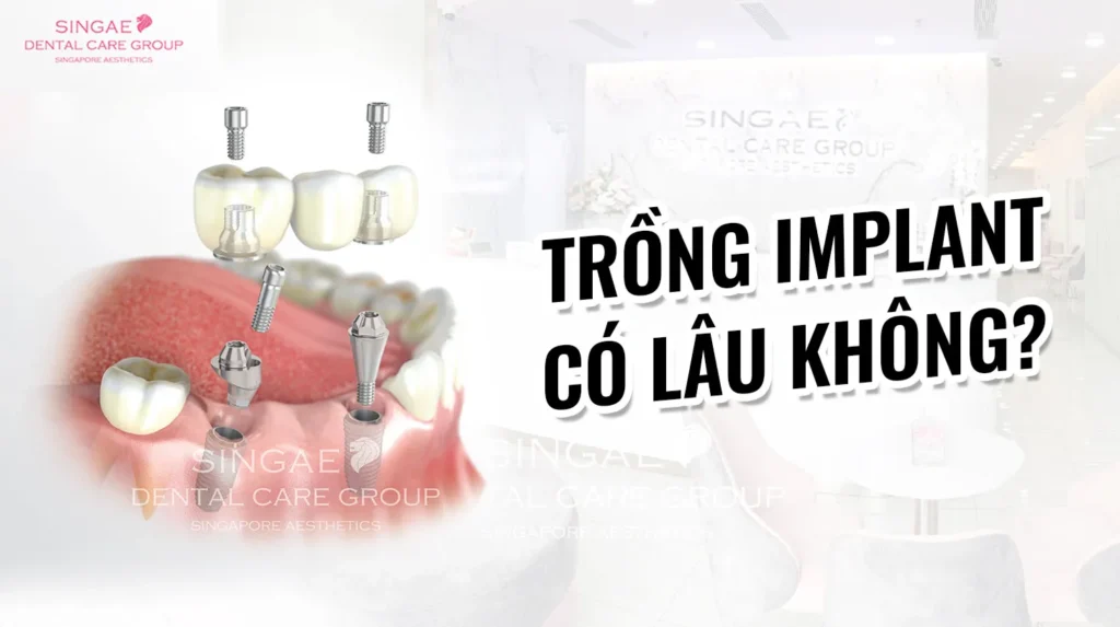 Trồng răng Implant mất bao lâu