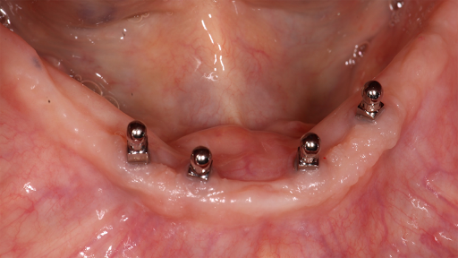 Trường hợp bị tiêu xương nặng bác sĩ sẽ chỉ định nên cắm Mini Implant