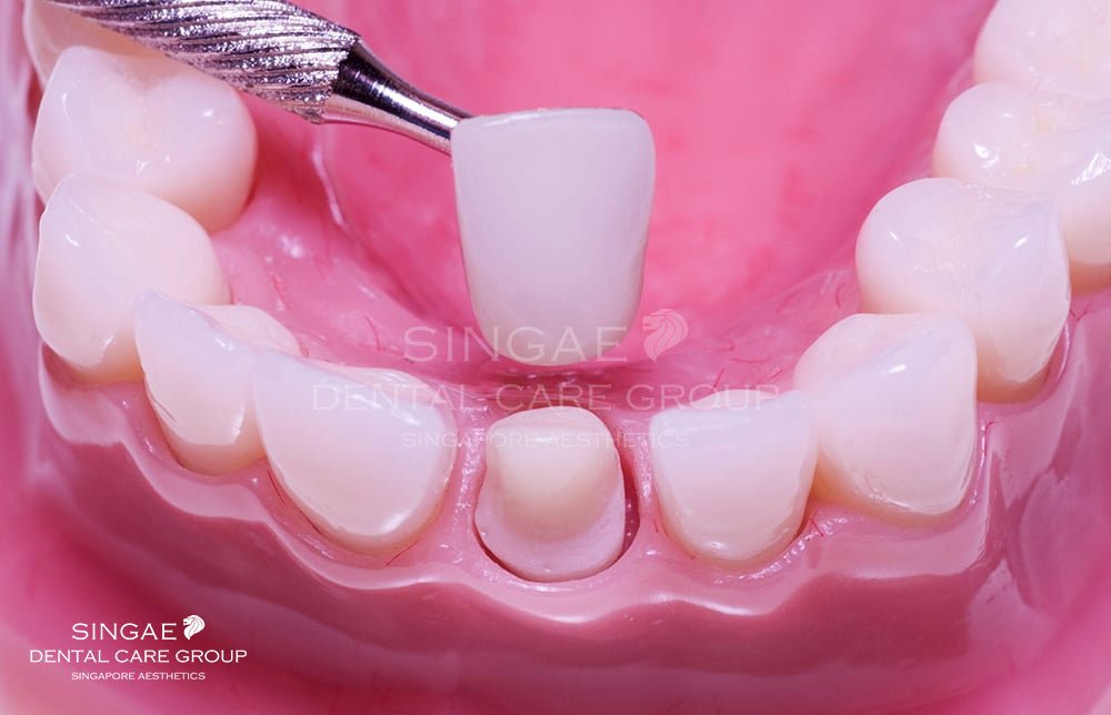 Bọc răng sứ tại Nha khoa Singae
