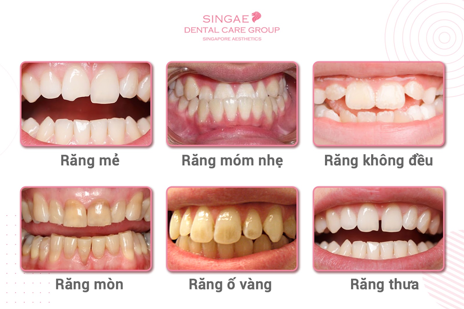 Chi phí niềng răng thẩm mỹ là bao nhiêu?
