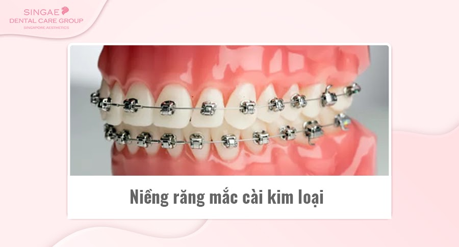 Chi phí niềng răng thẩm mỹ là bao nhiêu?