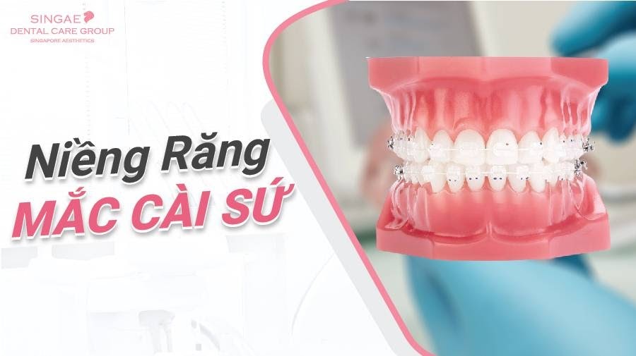 niềng răng thẩm mỹ3