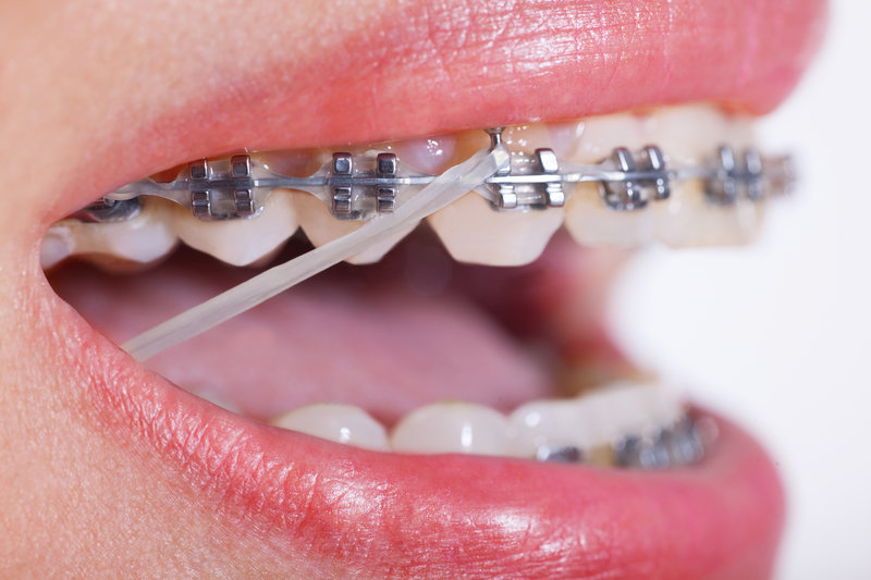 Niềng răng trả góp tại Nha khoa Sinage - Giảm bớt gánh nặng tài chính