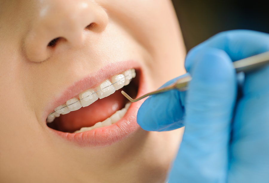 Niềng răng trả góp tại Nha khoa Sinage - Giảm bớt gánh nặng tài chính