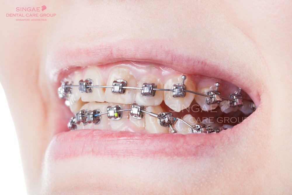 Niềng răng trả góp tại Nha khoa Sinage - Giảm bớt gánh nặng tài chính
