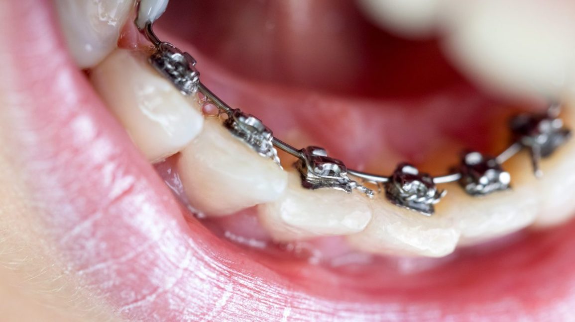 Niềng răng trả góp tại Nha khoa Sinage - Giảm bớt gánh nặng tài chính