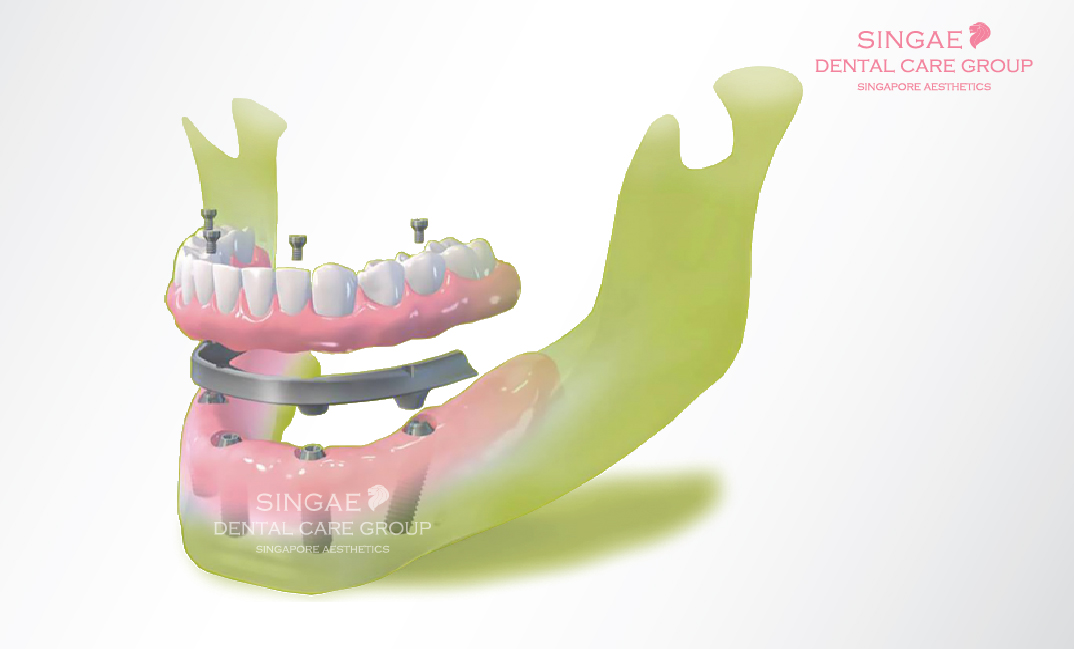 trồng răng Implant toàn hàm all on 4, all on 6 