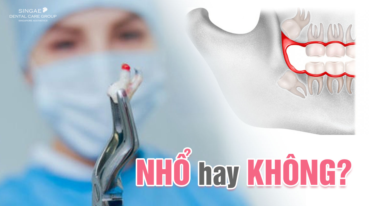 Vạch trần những lầm tưởng bấy lâu nay về mọc răng khôn hàm trên
