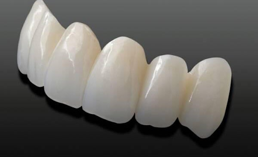 Bảng giá các loại răng sứ 