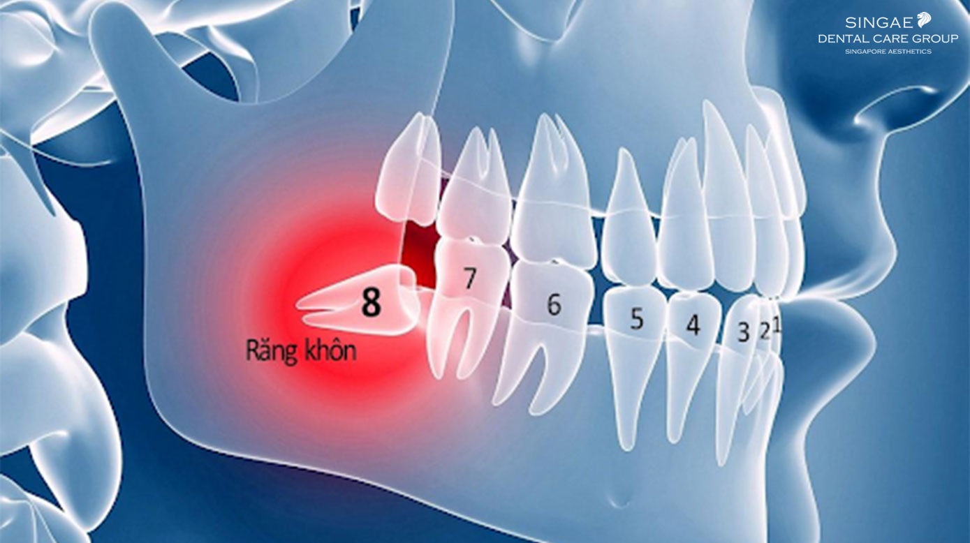 Đau răng khôn và những bí ẩn chưa ai tiết lộ với bạn