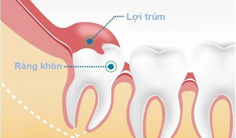 Dấu hiệu mọc răng khôn