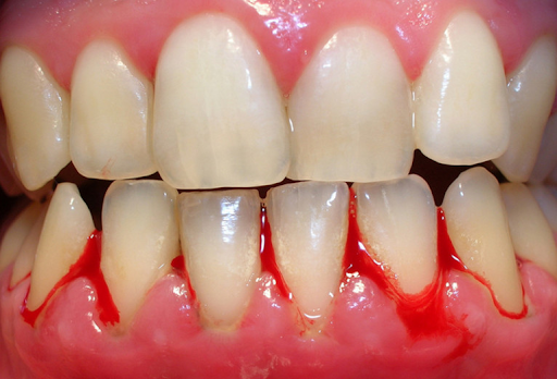 lắp răng sứ sai kỹ thuật2
