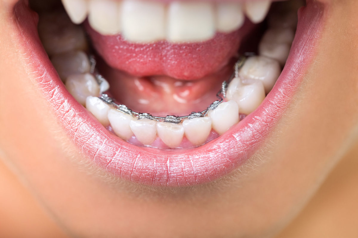 [ Niềng răng hàm dưới ] và những thông tin bạn nên biết