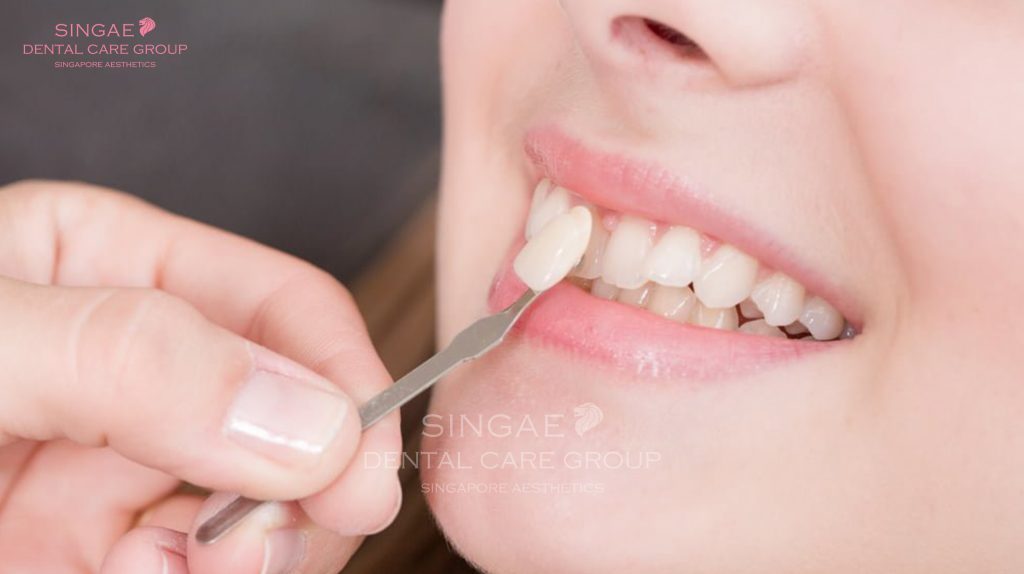 Dán sứ Veneer có bền không