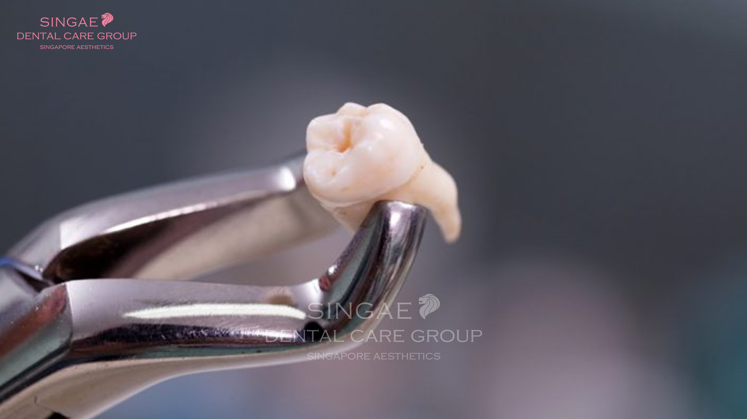 Viêm nướu răng khôn 