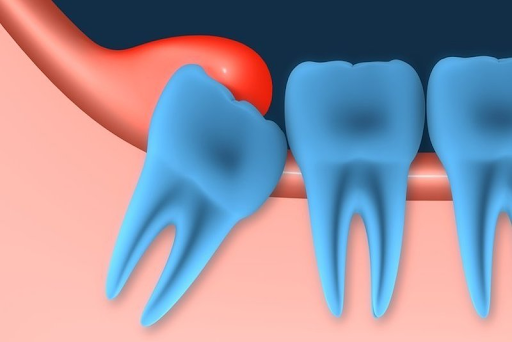 Dấu hiệu mọc răng khôn