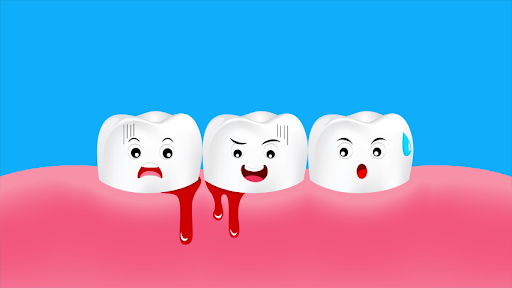 Bị chảy máu chân răng là bệnh gì