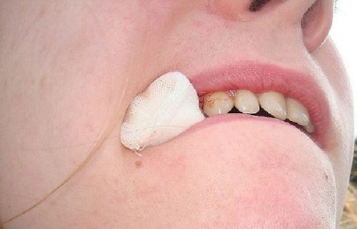 Cách cầm máu khi bị chảy máu chân răng