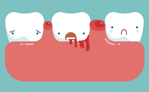 Chảy máu chân răng có phải bị ung thư không?