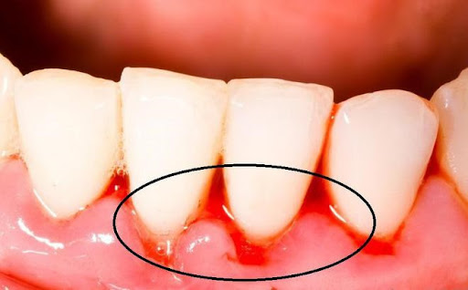 Chảy máu chân răng có phải bị ung thư không?