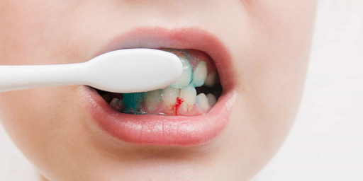 Chảy máu chân răng có phải bị ung thư không?