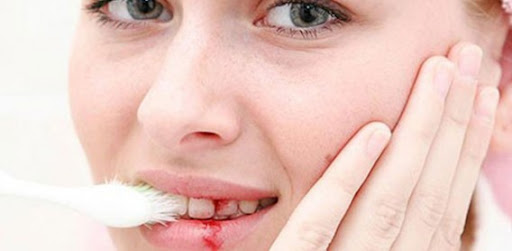 Chảy máu chân răng có phải bị ung thư không?