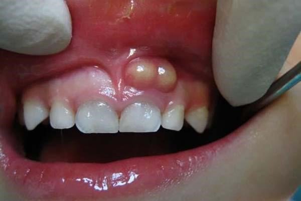 chảy máu chân răng thiếu chất gì