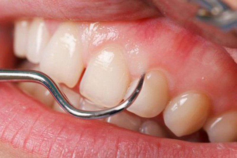 chảy máu chân răng thiếu chất gì