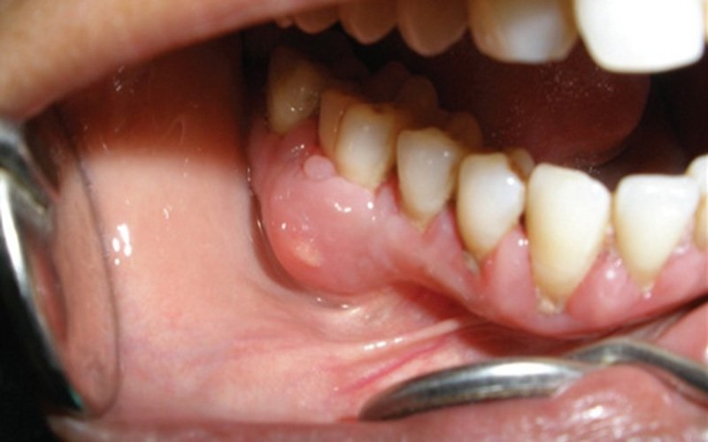 Áp xe răng do bị chảy máu chân răng