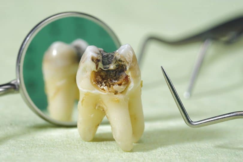 Răng số 8 bị sâu 