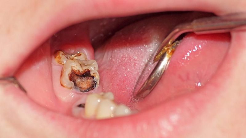 Răng số 8 bị sâu