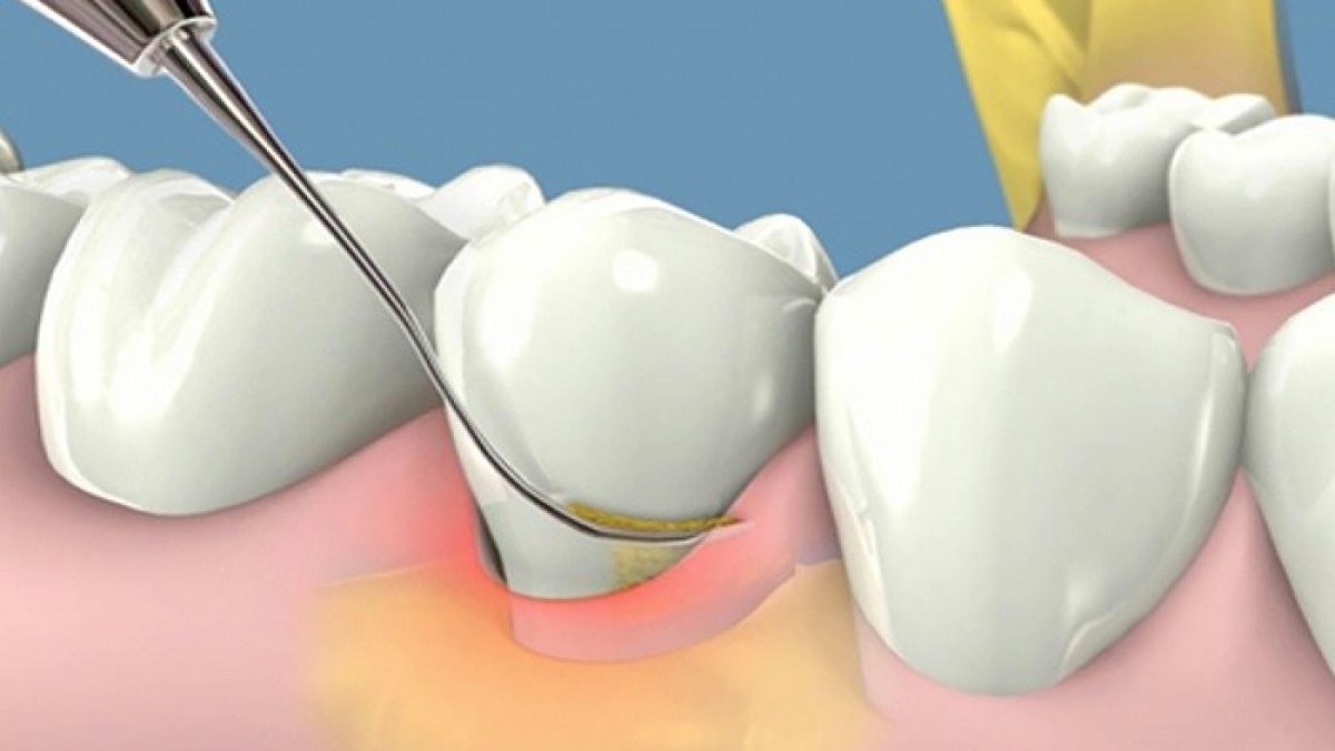 Góc giải đáp: Viêm lợi kiêng ăn gì và nên ăn những thực phẩm nào 24 Điều trị viêm nướu răng như thế nào?