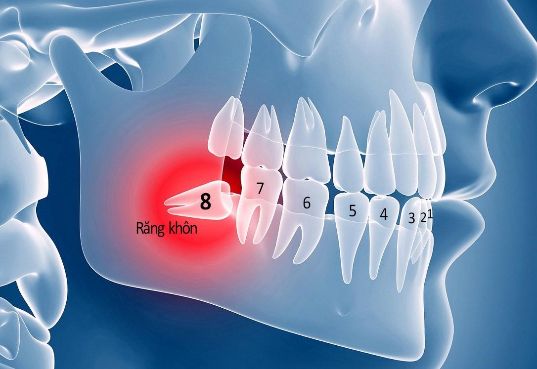 Mọc răng khôn là nguyên nhân đau nhức răng 
